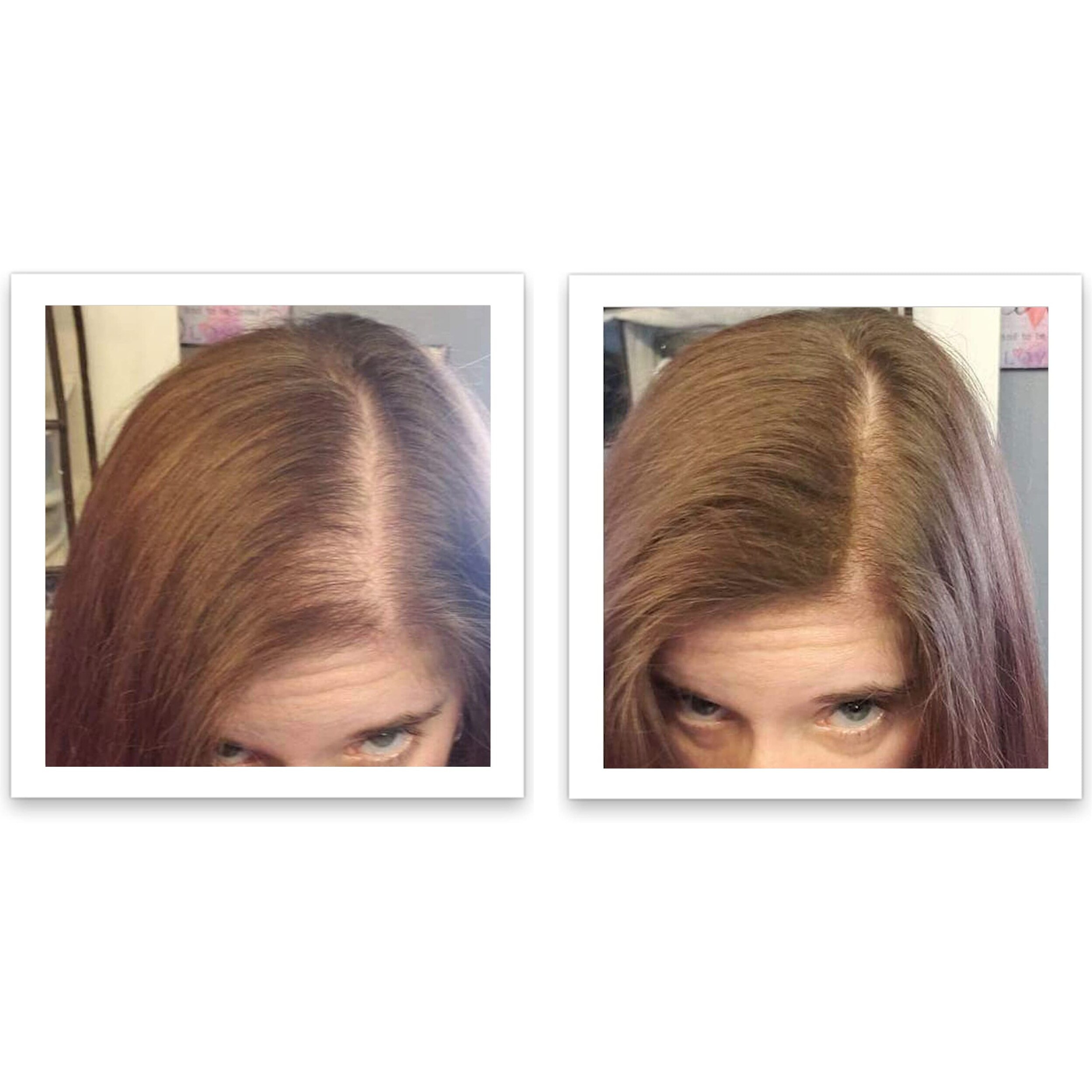 Caboki All-Natural Hair Building Fiber. Make Thin Hair Look 10X Fuller Instantly. Eliminate The Appearance Of Bald Spot And Thinning Hair (30G, 90-Day Supply). Medium Brown